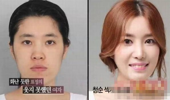 韩国惊人整容新案例 歪脸妹变美女