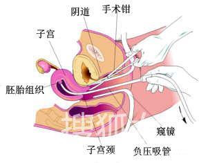 图片详解<em>流产手术</em>全过程