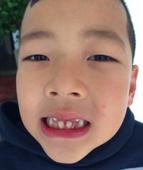     搜狐娱乐讯 《爸爸去哪儿》近日热播，郭涛家6岁的石头哥哥正经历着换牙。10日下午，郭涛在网上...
